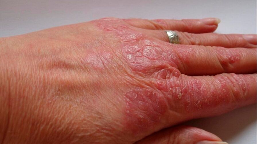Symptome von Psoriasis an den Händen