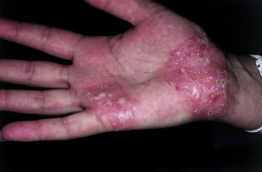 Verschlimmerung der Psoriasis an den Händen