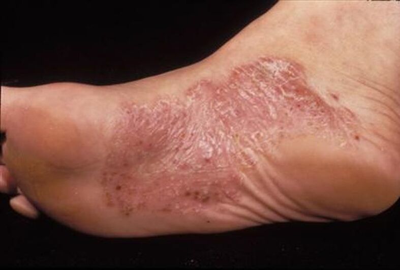 Symptome der Psoriasis am Fuß