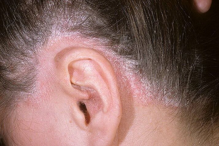 Psoriasis-Ausschläge am Kopf hinter den Ohren