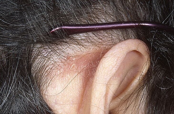 Psoriasis-Plaque hinter dem Ohr
