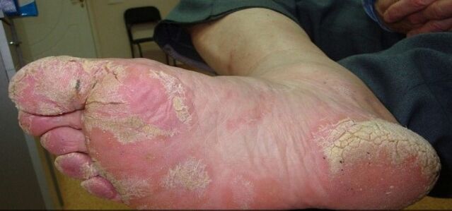 Beinpsoriasis