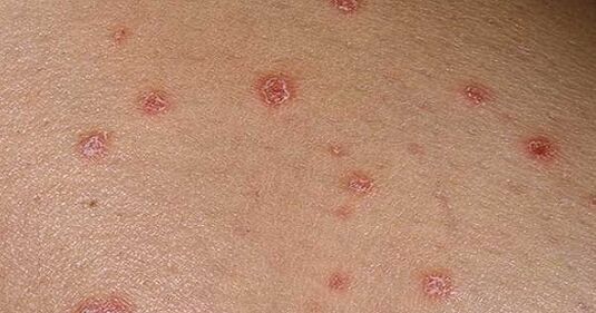 Psoriasis -Platten