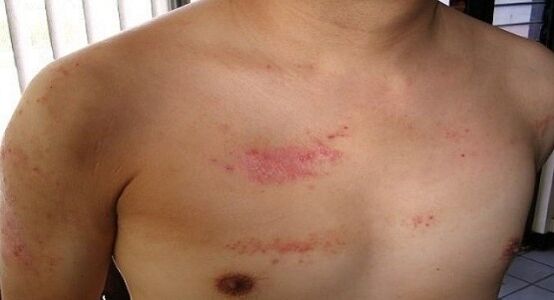 Psoriasis im Brustbereich