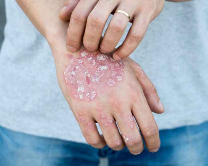 Psoriasis in den Händen