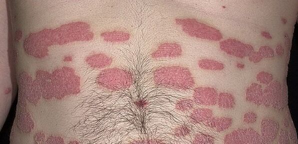 Soriasis