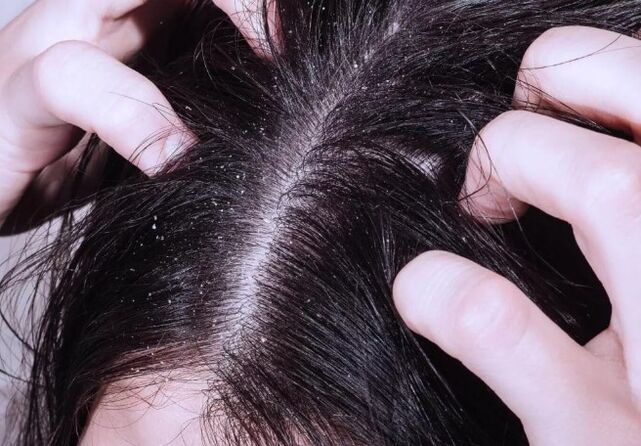 Psoriasis im Kopf