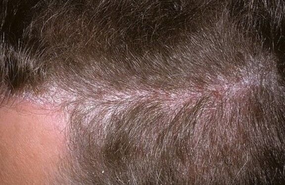 Psoriasis im Kopf