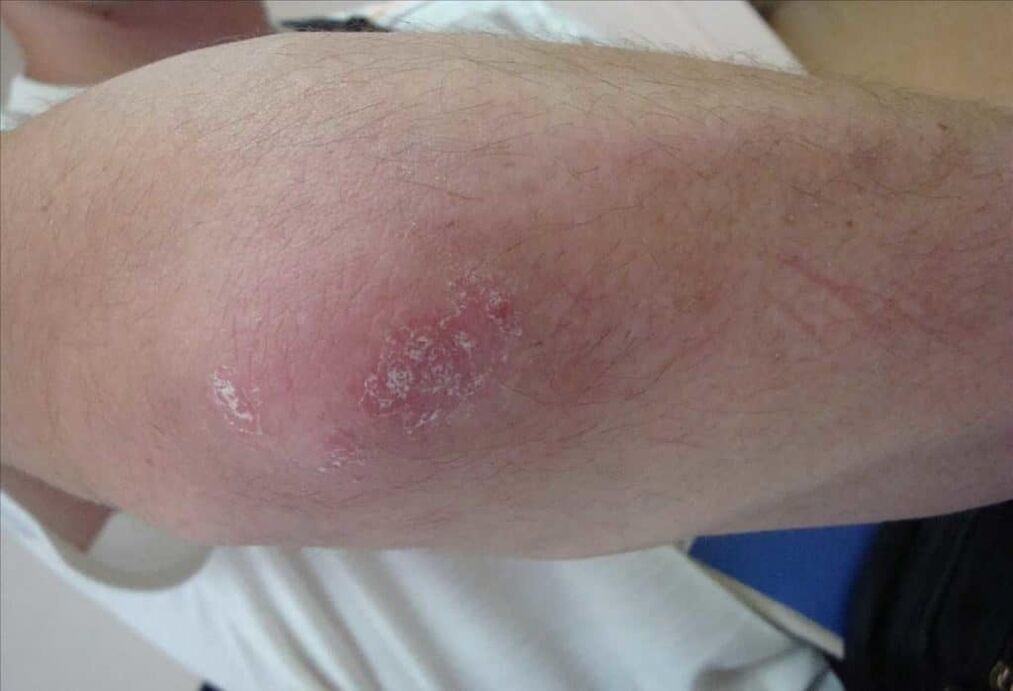Wie Psoriasis aussieht