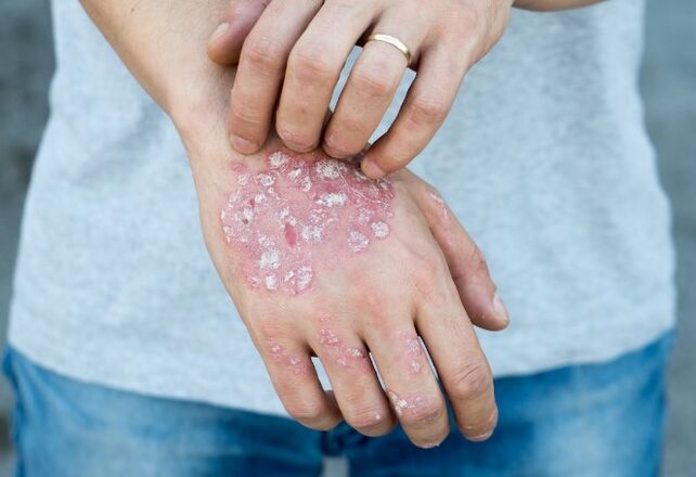 Mesnicherierte Psoriasis