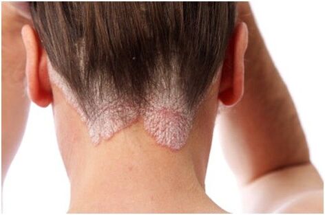 Haarsporiasis