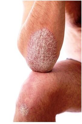 Psoriasis im Ellbogen