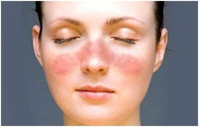 Psoriasis im Gesicht
