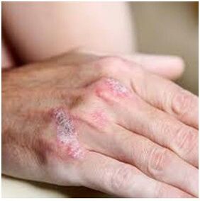 Psoriasis in der Bürste