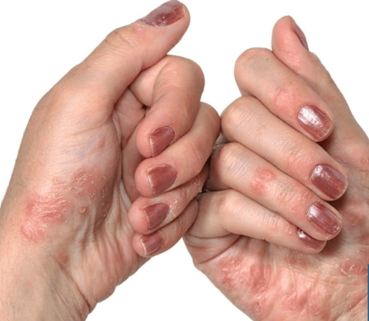 Psoriasis in den Händen