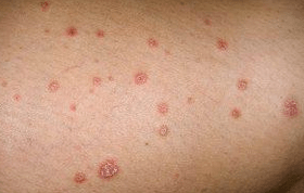 Psoriasis -Platten