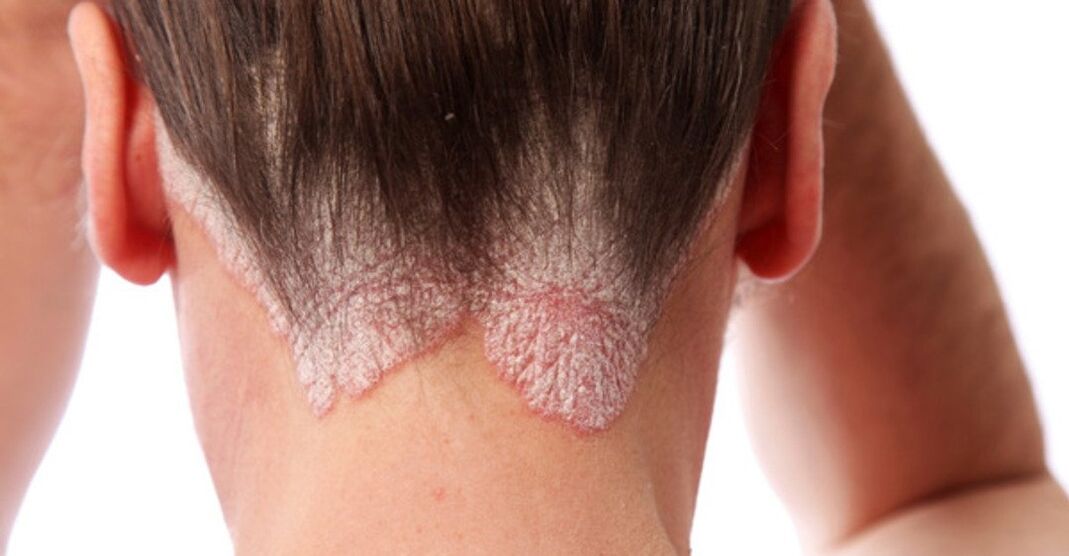 Psoriasis am Kopf der Mädchen