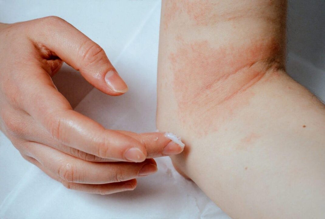 Psoriasis -Behandlung