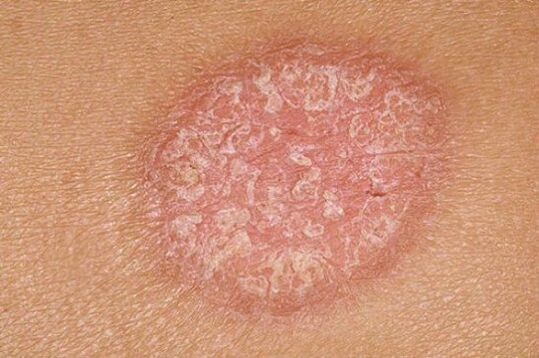 Soriasis