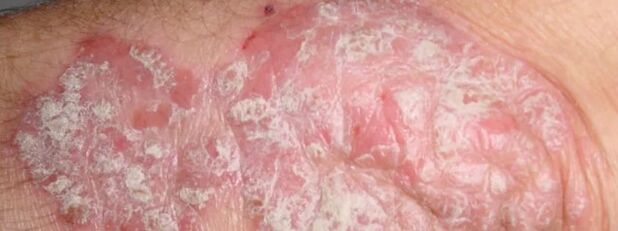 Mesnicherierte Psoriasis