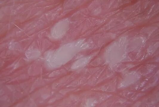 Psoriasis von Pustulenien
