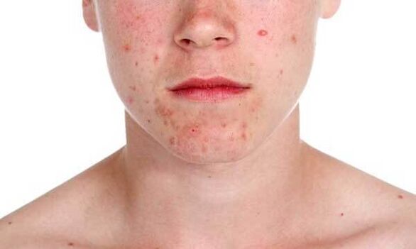 Psoriasis -Symptome