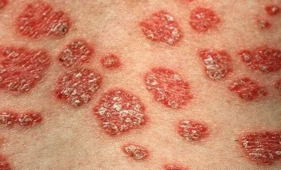 Psoriasis Formen