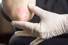 Psoriasis im Ellbogen