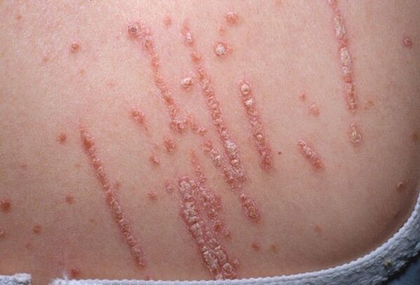 Psoriasis im Körper