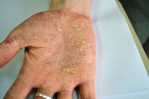 Psoriasis in Ihrer Handfläche