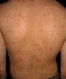 Plaque-Psoriasis