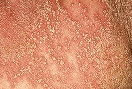pustulöse Psoriasis