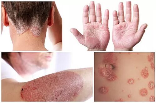 Manifestationen der Psoriasis an verschiedenen Stellen des Körpers.