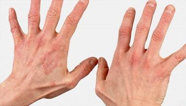 Wie sieht das Anfangsstadium der Psoriasis aus