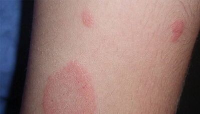 Wie äußert sich das Anfangsstadium der Psoriasis