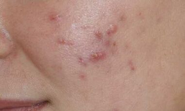 Symptome einer Psoriasis im Frühstadium