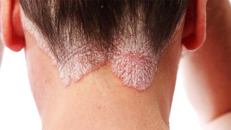 Psoriasis-Plaques auf der Kopfhaut.