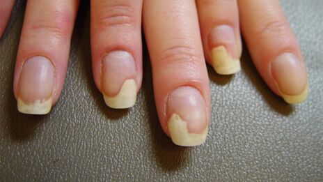 Weiße Flecken auf den Nägeln aufgrund von Psoriasis.