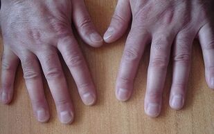 Psoriasis-Symptome im Anfangsstadium