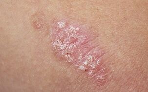 Ursachen der Psoriasis