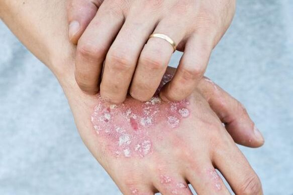 Charakteristische Symptome einer Psoriasis an den Händen.