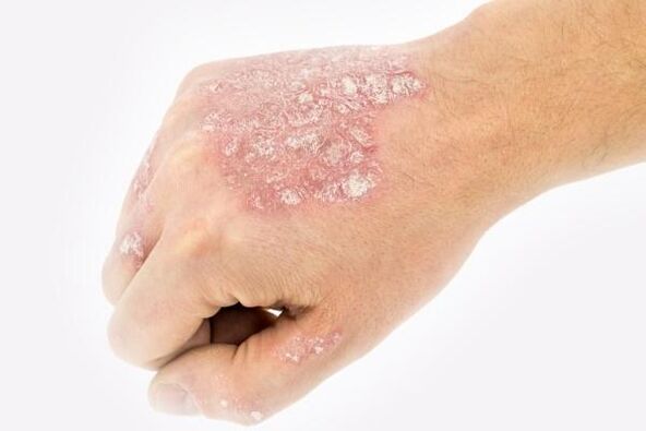Entstehungsmechanismus der Psoriasis an den Händen.