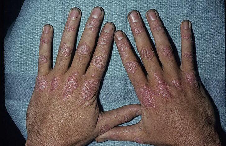 Gründe für die Entstehung einer Psoriasis an den Händen.