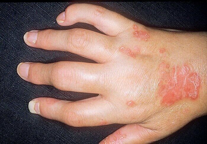 Psoriasis-Arthritis in den Händen