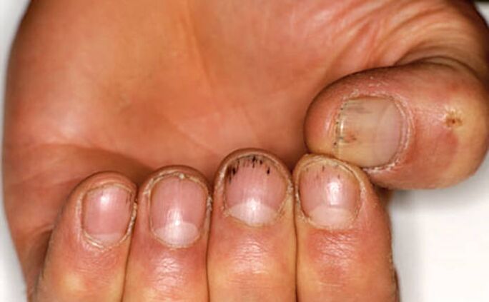 Blutung unter den Nägeln mit Psoriasis. 