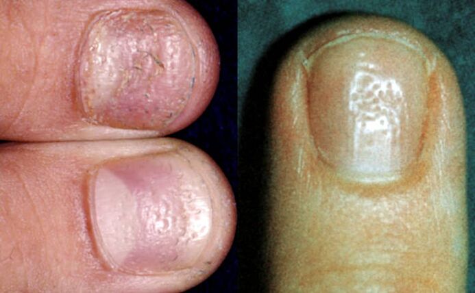 Fingerhut Symptom mehrere Vertiefungen auf der Nagelplatte Oberfläche