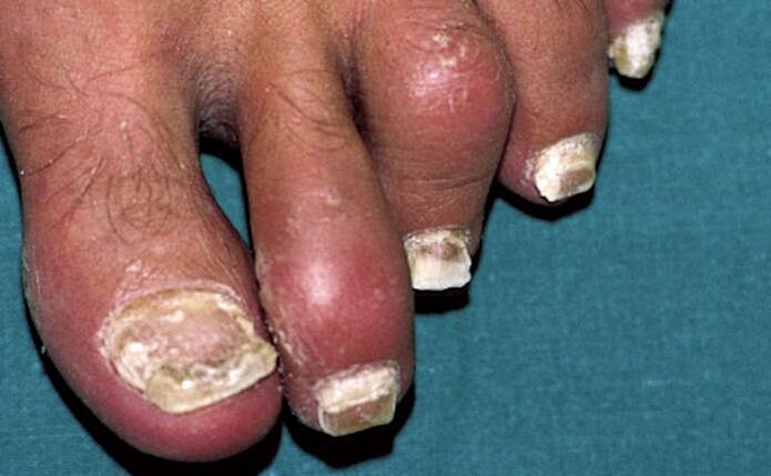 Psoriasis mit Beteiligung der Nägel und Entzündung der Gelenke (Arthritis) der Zehen